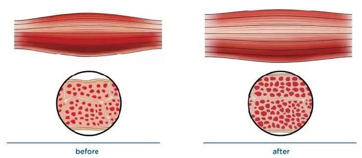 Emsculpt Neo muscle building principle animation picture