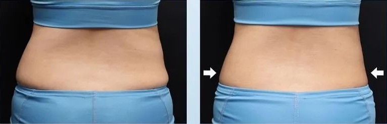 Emsculpt Neo waist fat reduction before and after picture
