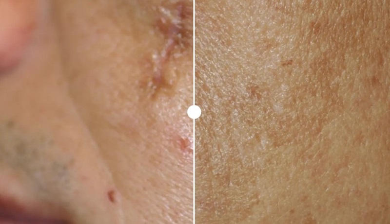 Fraxel Dual laser treatment of acne scars before and after picture