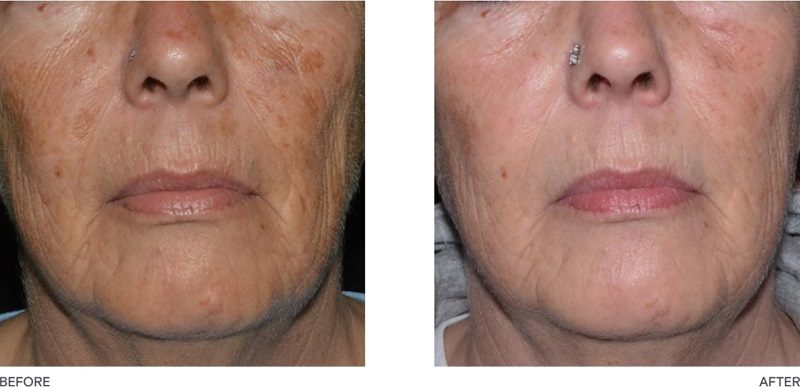 LaseMD laser treatment for melasma before and after