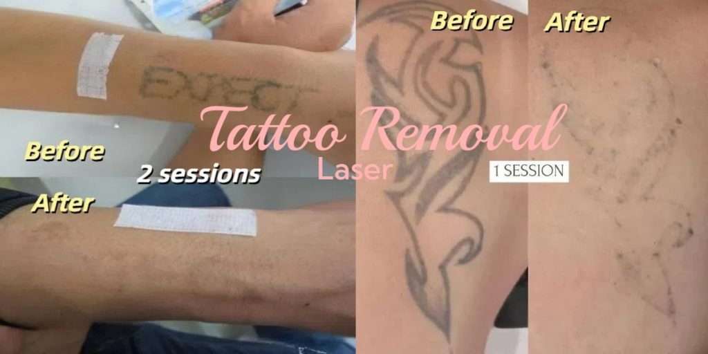 Laser Tattoo Removal Before and After Pictures