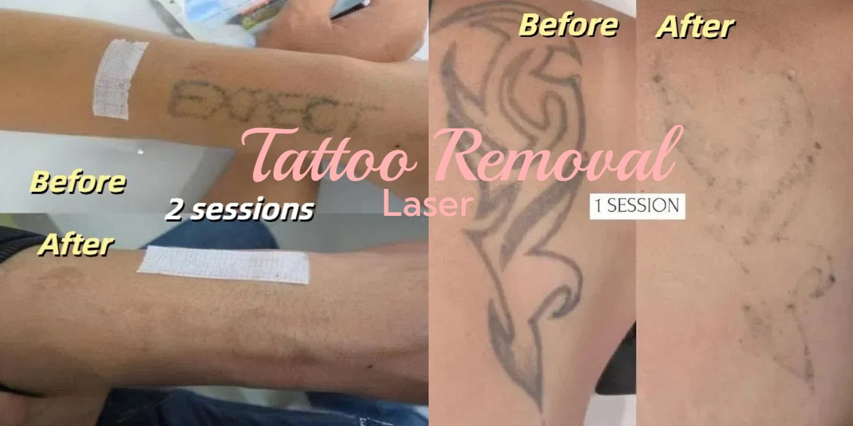 Laser Tattoo Removal Before and After Pictures