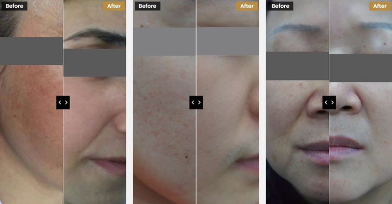 Lavieen Laser Skin Treatment Before and After Pictures