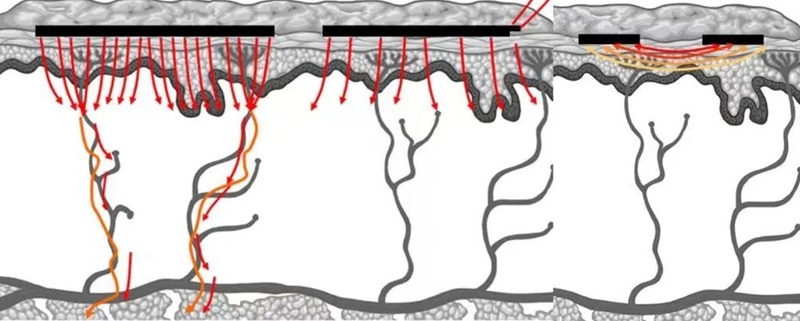 Thermage deep tissue heating vs bipolar RF superficial heating