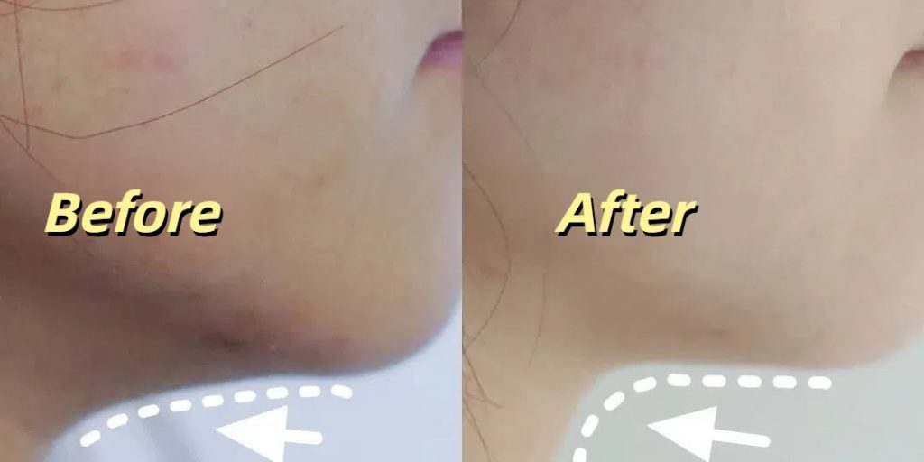 Thermage jawline lift before and after