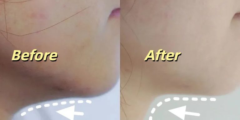 Thermage jawline lift before and after