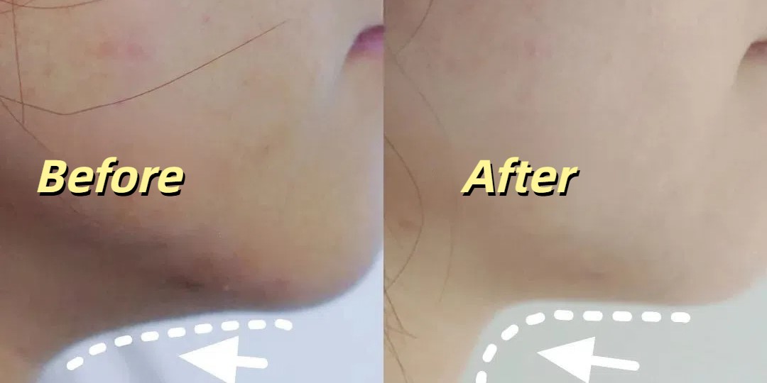 Thermage jawline lift before and after