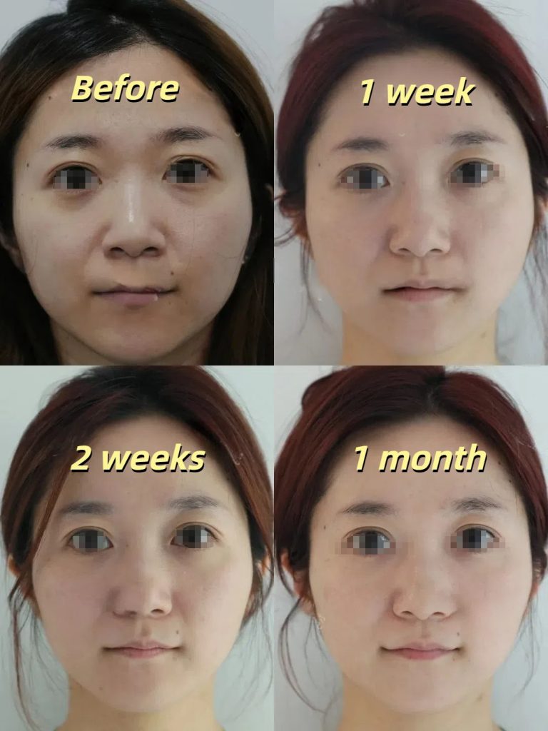 Thermage skin tightening before and after