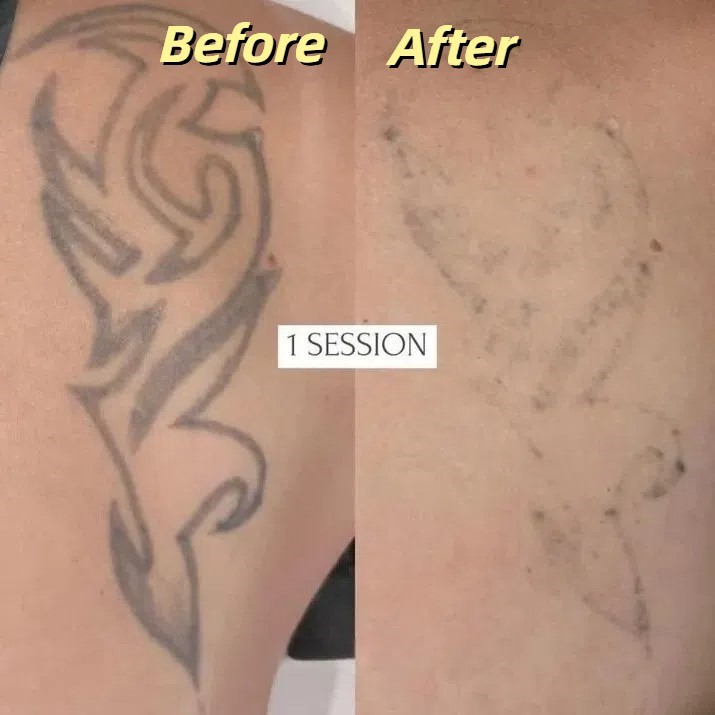 pico laser tattoo removal before and after 1 session