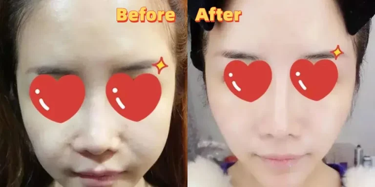 1 session HIFU before and after photos