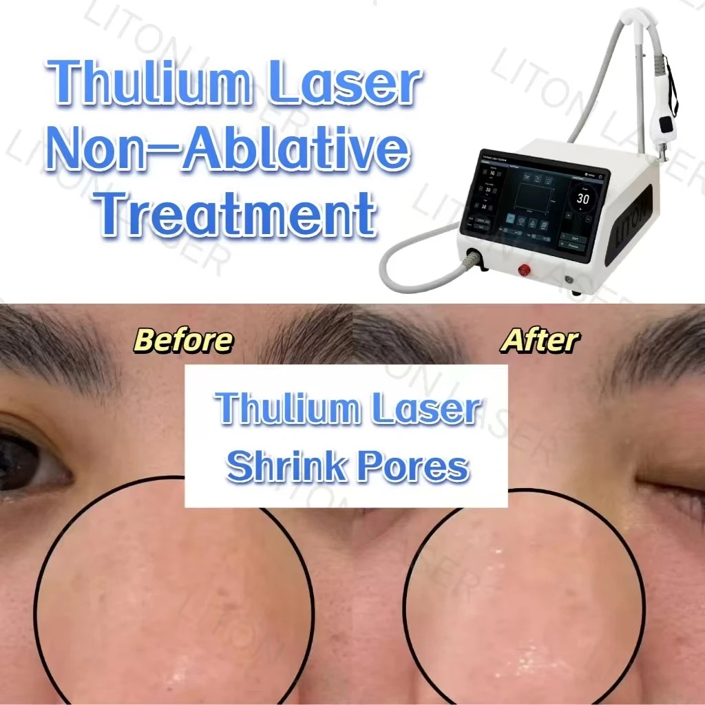 1927nm Thulium laser before and after shrinking pores