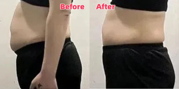 Abdominal fat cavitation before and after