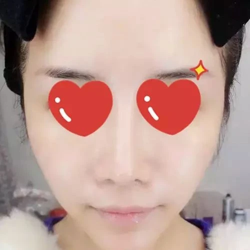 After HIFU treatment