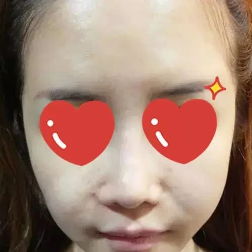 Before HIFU treatment
