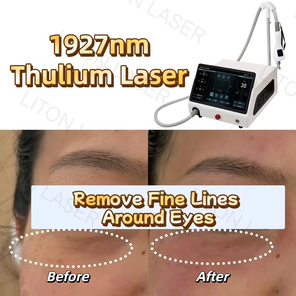 Thulium laser wrinkle removal in the eye area before and after