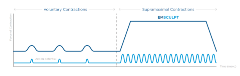 Comparison of muscle contraction with Emsculpt Neo machine and normal exercise