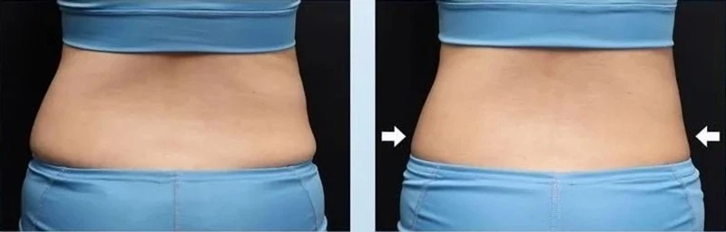 EMS Body Sculpting waist fat reduction before and after picture