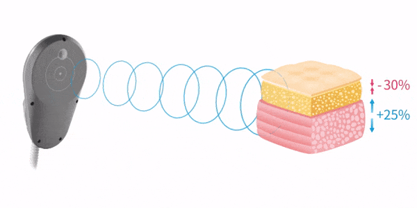 Emsculpt Neo reduces fat by 30% and increases muscle by 25% animation