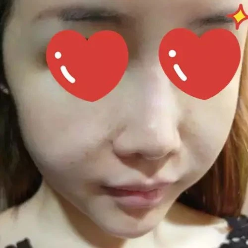 End of HIFU treatment