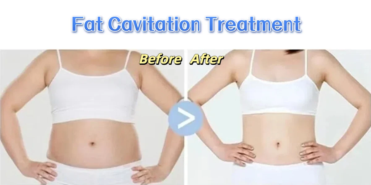 Fat Cavitation Treatment Before and After Photo