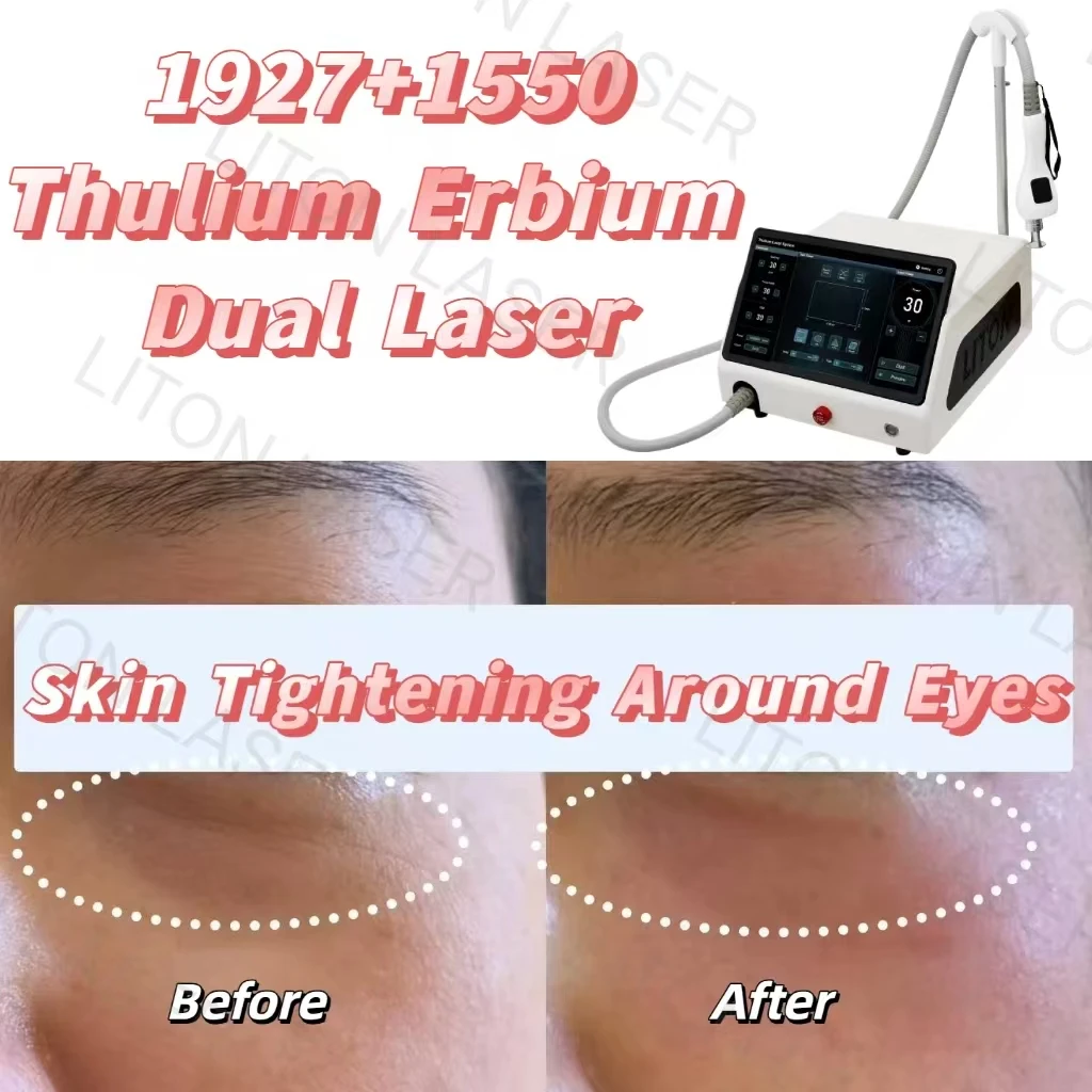 Thulium Erbium Dual Laser Skin Tightening Around Eyes Before and After