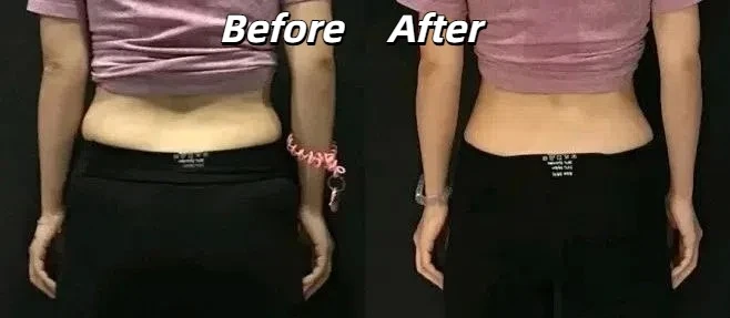 Waist fat cavitation treatment before and after