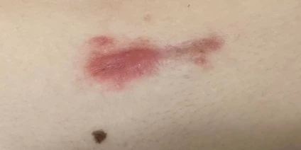 After 1 session CO2 laser scar treatment