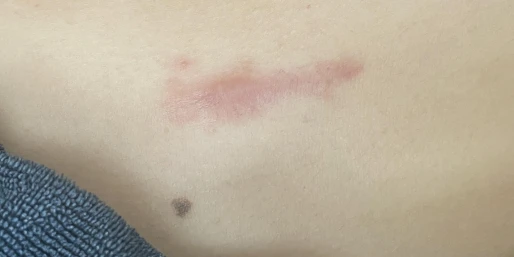 After 2 sessions of CO2 laser treatment for scars