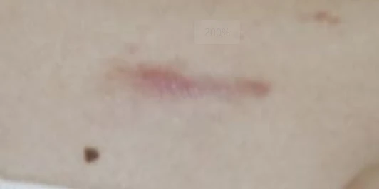 After 3 sessions of CO2 laser scar treatment