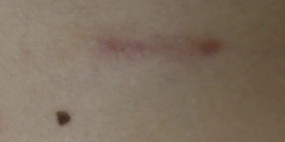 After 4 sessions of CO2 laser scar treatment