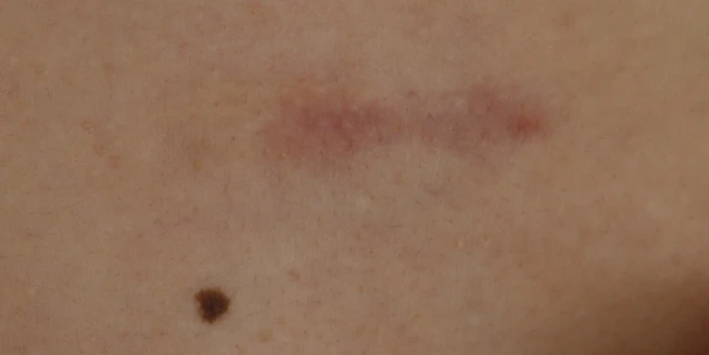 After 5 sessions of CO2 laser scar treatment