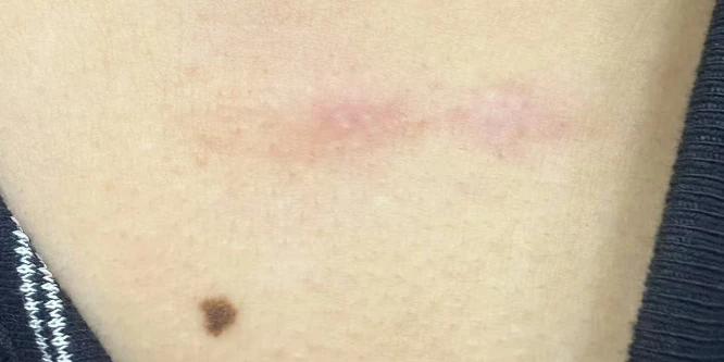 After 6 sessions of CO2 laser scar treatment