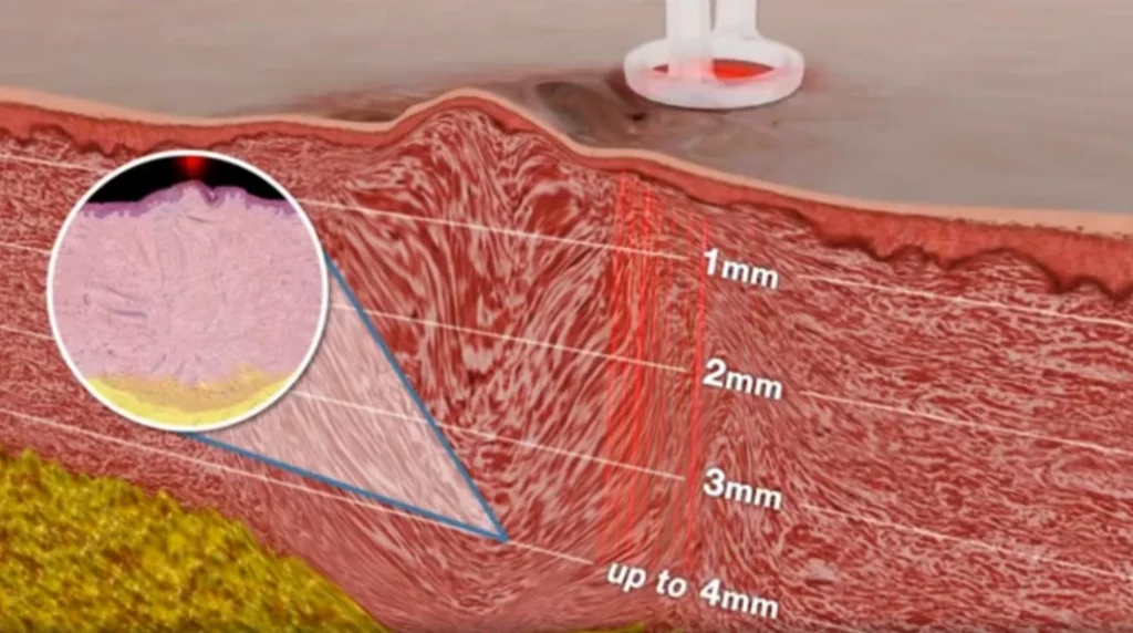 Animated images of CO2 laser scar resurfacing