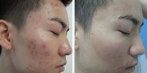 Blue LED Light Therapy Acne Treatment Before and After