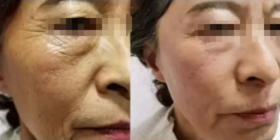 CO2 fractional laser anti-aging before and after