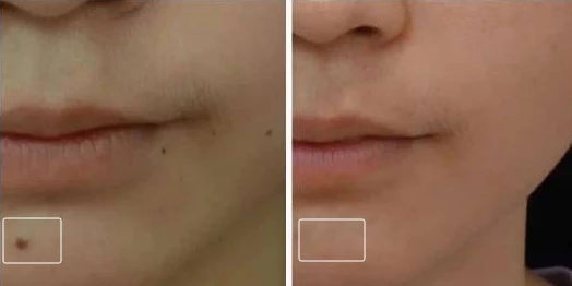 CO2 fractional laser removal of pigmented nevus before and after