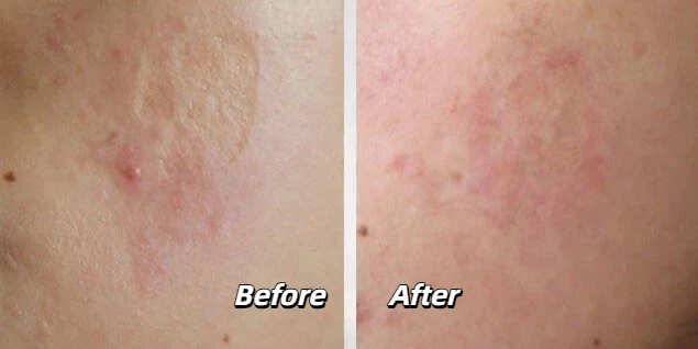 CO2 laser treatment for facial scars before and after
