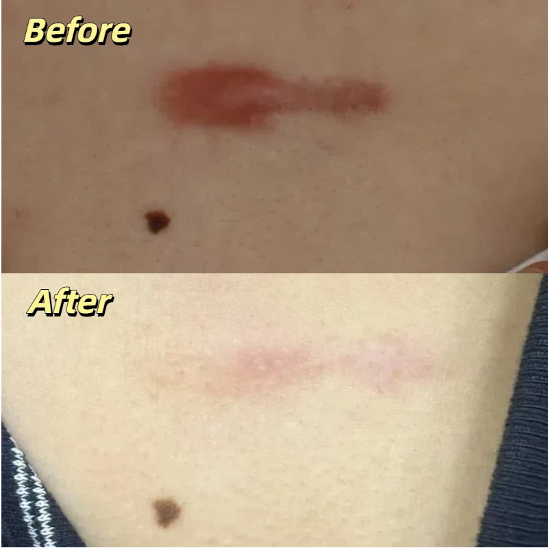 CO2 laser treatment for skin scars before and after