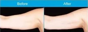 Coolsculpting Arms Before and After