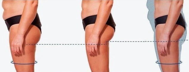 Coolsculpting Before and After Photos