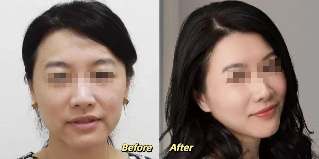 Coolsculpting Chin Before and After
