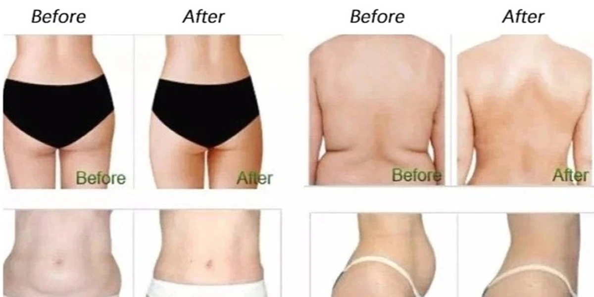 Cryolipolysis body back slimming before and after