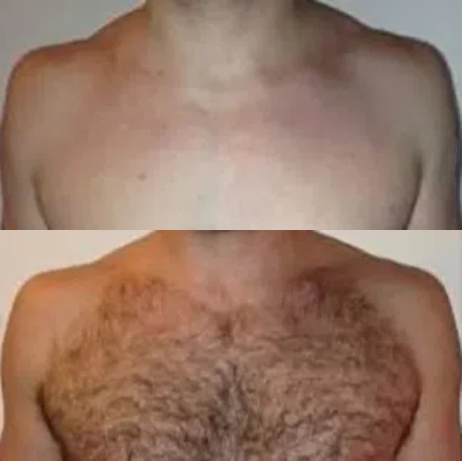 Diode laser chest hair removal before and after