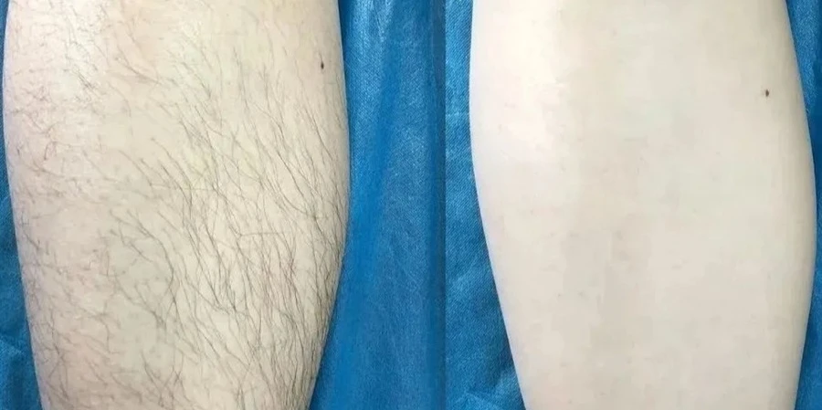 Diode laser leg hair removal before and after