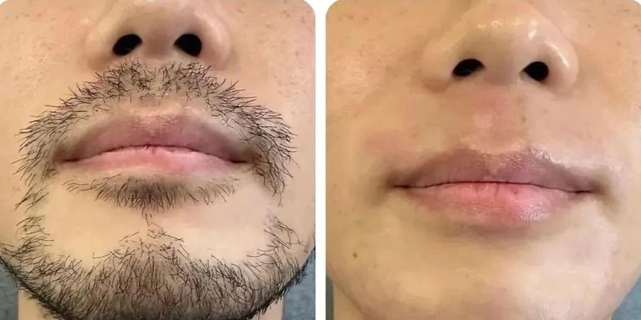 Diode laser upper lip hair removal before and after