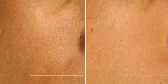 Fractional CO2 laser shrinking pores before and after