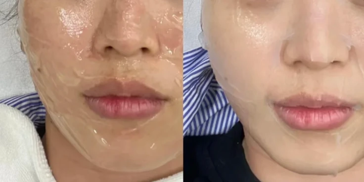 IPL photofacial before and after