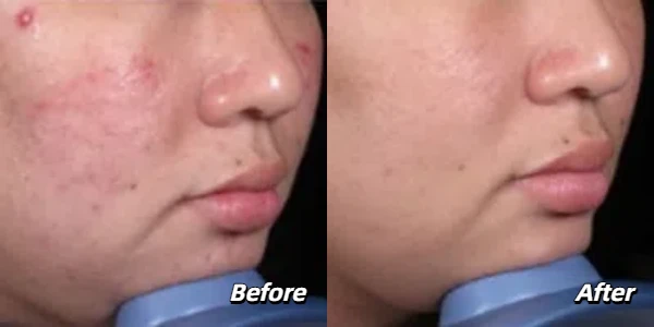 IPL treatment for rosacea before and after photos