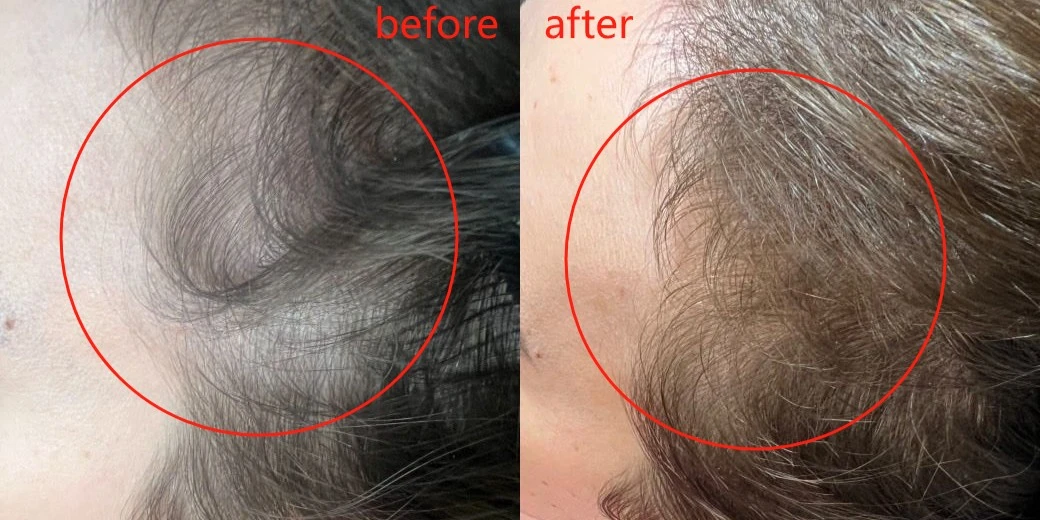 Red LED light therapy for hair growth before and after
