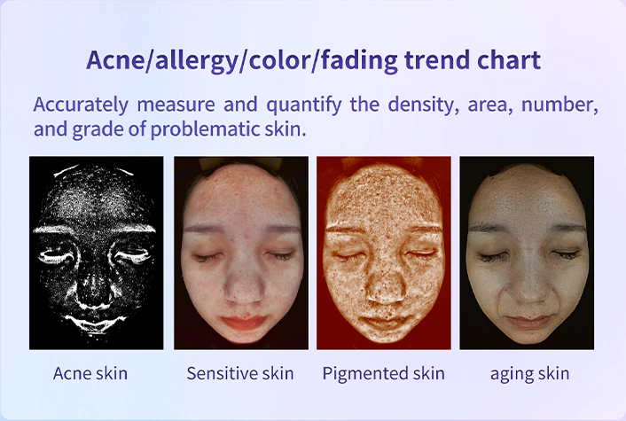Skin analysis machine detects patient's facial skin issues